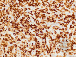 ALCL, lymphohistiocytic variant, CD30 IHC