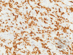 ALCL, lymphohistiocytic variant, CD163 IHC