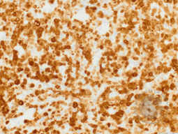 ALCL, lymphohistiocytic variant, ALK IHC