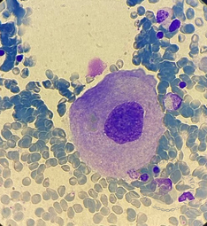 Dysmegakaryopoiesis