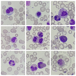 Myelodysplastic Syndrome