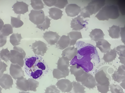 Bilirubin crystals 4