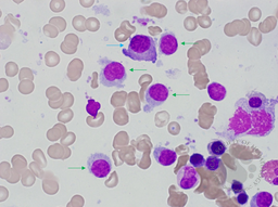 Hairy Cell Leukaemia and Multiple Myeloma 1