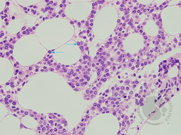 Hairy Cell Leukaemia and Multiple Myeloma 3