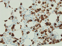 Hairy Cell Leukaemia and Multiple Myeloma 4