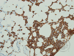 Hairy Cell Leukaemia and Multiple Myeloma 5