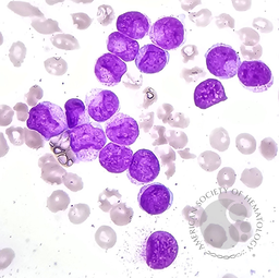Acute myeloid leukemia with Cup-like blasts 1