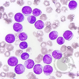 Acute myeloid leukemia with Cup-like blasts 2