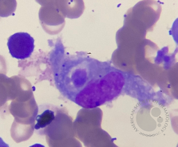Hemophagocytosis figures following CART Cell Therapy 1