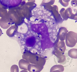 Hemophagocytosis figures following CART Cell Therapy 2