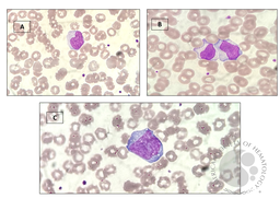 Downey Cells in Infectious Mononucleosis: Decoding the Role of Lymphocyte Abnormalities in Diagnosis