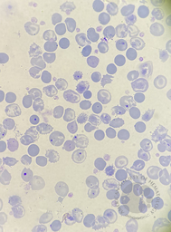 beta-thalassemia major