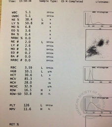 EDTA vacutainer showing immediate clotting of the sample , not allowing the sample to be tilted for mixing with the anticoagulant. Normal control samp