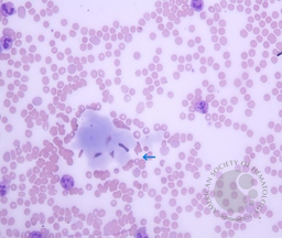 Figure 5. Peripheral smear 40X, Leishman Stain showing pale blue deposits of cryoglobulins in the body of the smear
