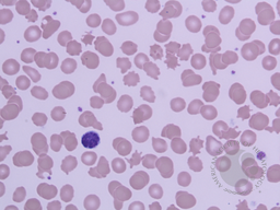 Peripheral smear 100X, Leishman Stain showing multiple acanthocytes