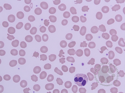 Peripheral smear 100X, Leishman Stain showing multiple acanthocytes along with one Eosinophil