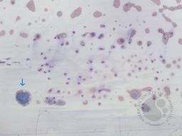 Figure 5. Peripheral smear 10X, Leishman Stain showing multiple pale blue deposits of cryoglobulins in the tail end of the smear
