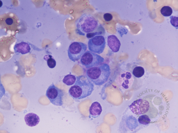 Figure 6. Bone marrow aspirate smear 100X, Geimsa stain showing clusters of Plasma cells in a pale blue background.
