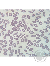 Hereditary Elliptocytosis