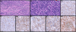 B-ALL relapse presenting as bilateral testicular swelling