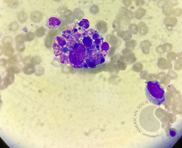 Hemophagocytosis