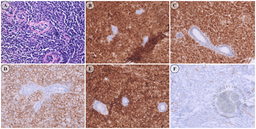 Unusual Presentation: Relapse of B-Cell Acute Lymphoblastic Leukemia as a Breast Mass