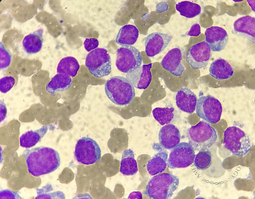 Bone marrow aspirate revealed 92% clonal plasma cells with atypical morphology (Fig A).