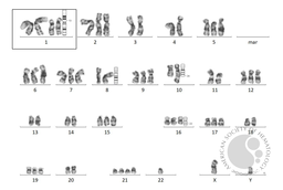 Karyotyping showed a complex hyperdiploid karyotype and 1q gain with 1p deletion (Fig B).