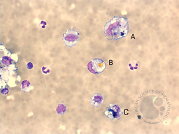 Hematin Crystals in Cerebrospinal Fluid