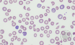 Thrombotic thrombocytopenic purpura