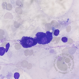 Mast cell in Bone Marrow Aspiration