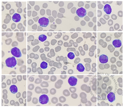 T-cell prolymphocytic leukemia (T-PLL)