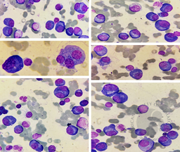 Plasma cell dyscrasia 1