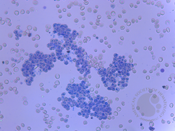 Isolated agglutination of reticulocytes sparing mature red blood cells in Epstein Barr virus infected child