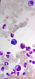 MOTT CELLS IN BONE MARROW ASPIRATE SMEARS