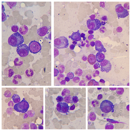 Plasma cell myeloma