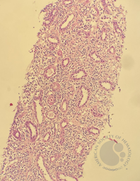 Renal biopsy involved by follicular lymphoma, low-power