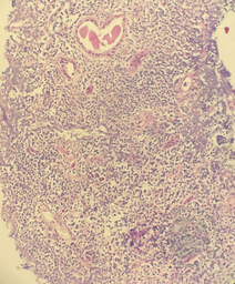 Renal biopsy involved by follicular lymphoma, intermediate-power