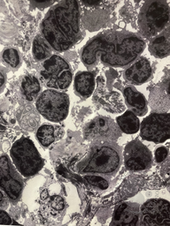 Follicular lymphoma by electron microscopy #2