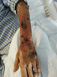 Invasive Fusarium infection