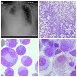 Flow Cytometry an Important Diagnostic Tool in Myelomatous Pleural Effusion 1
