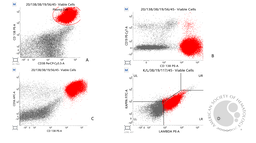 Flow Cytometry an Important Diagnostic Tool in Myelomatous Pleural Effusion 2