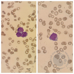 Blasts in Acute Promyelocytic Leukemia