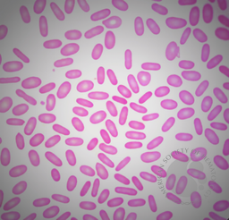 Hereditary Elliptocytosis