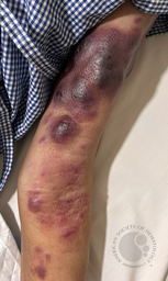 Mycosis fungoides