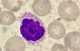 Sezary Cell 1