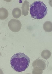 Sezary Cell 2