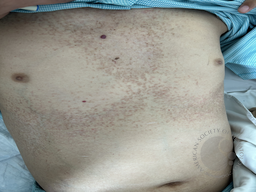 Eczematous papules on skin