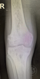 Lytic bone lesions with sclerosed margins 1