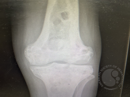 Lytic bone lesions with sclerosed margins 2